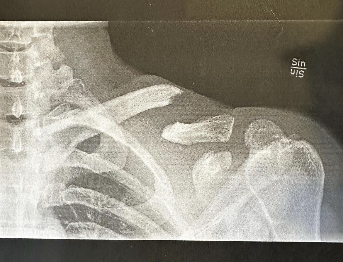 Broken shoulder for Josep Garcia in Swedish EnduroGP crash